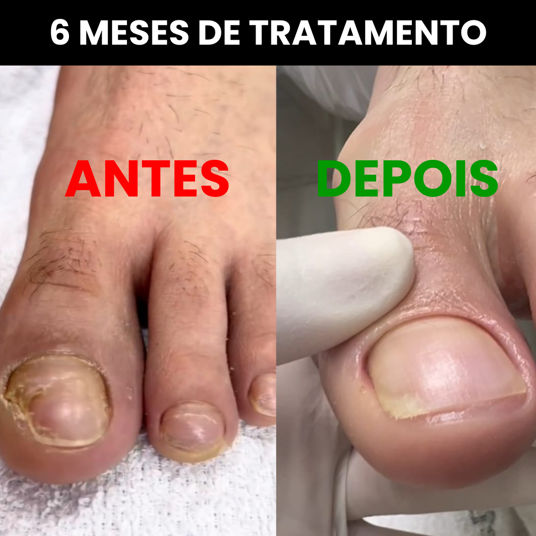 ANTES (10)